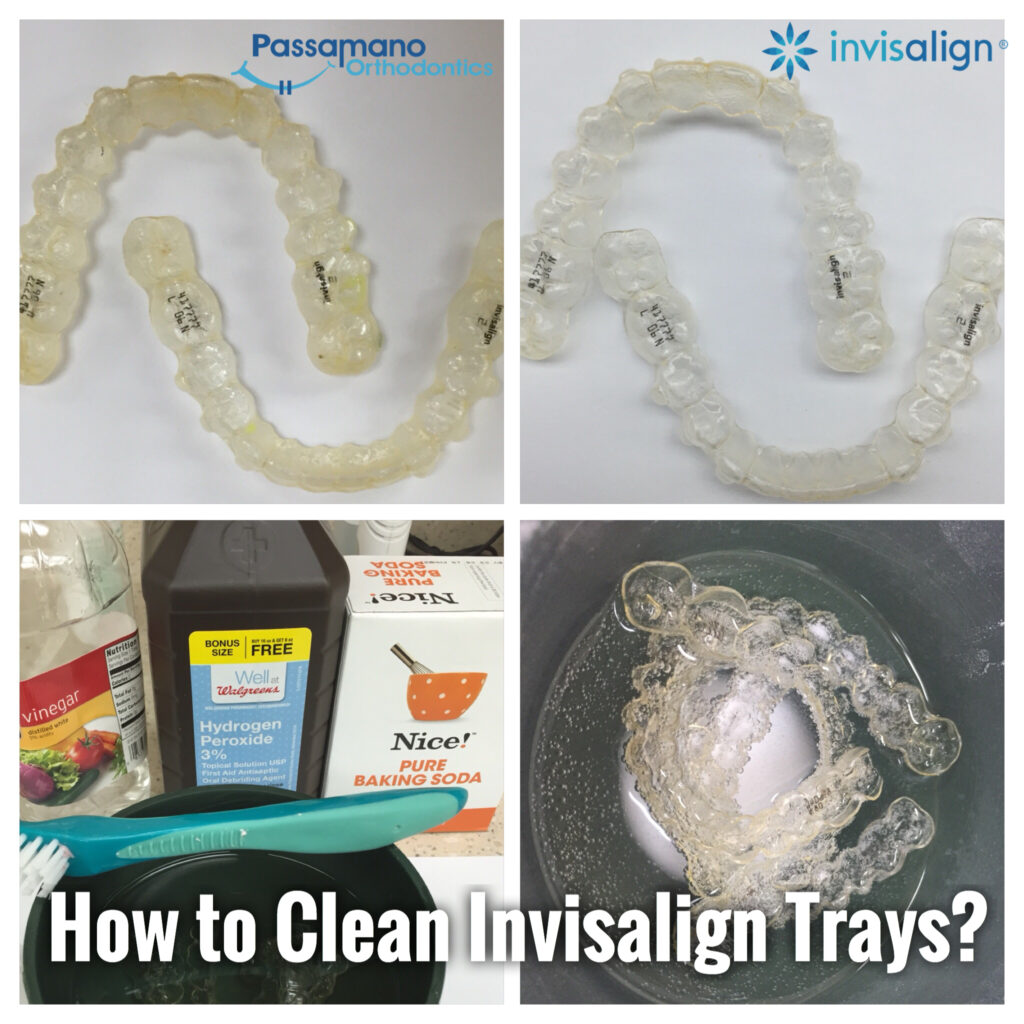 How to Clean a Crusty Invisalign Tray or Retainer at Home
