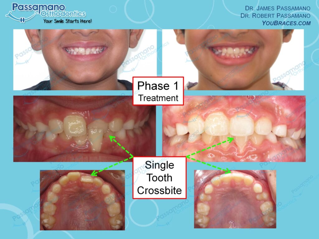 Single Tooth Crossbite Phase Treatment Passamano Orthodontics