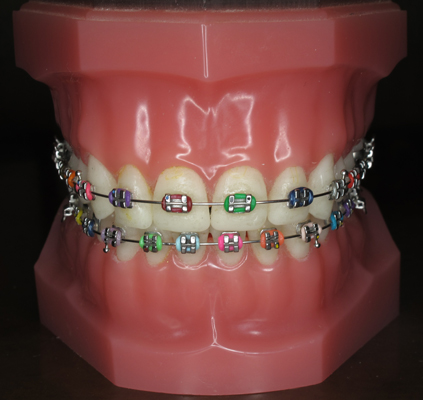 Metal_Braces_PassamanoOrtho | Passamano Orthodontics Irvine, CA ...