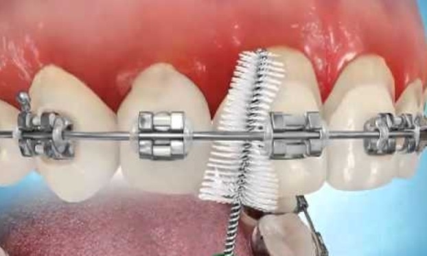 How to Brush Your Teeth with Braces - Duff Family Dental