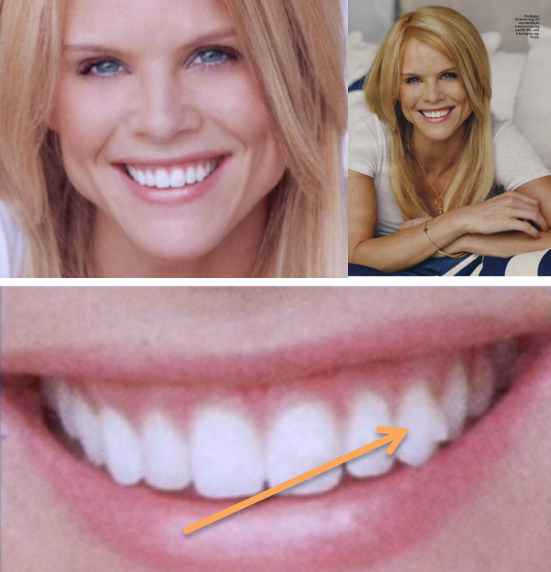 Elin Nordegan Invisalign Attachment