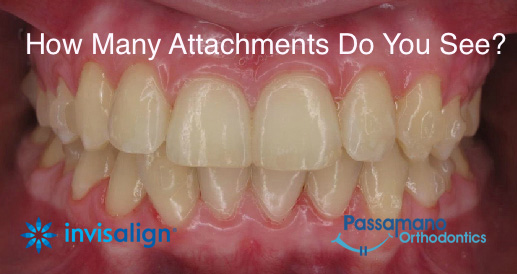 How Many Invisalign Attachments copy copy