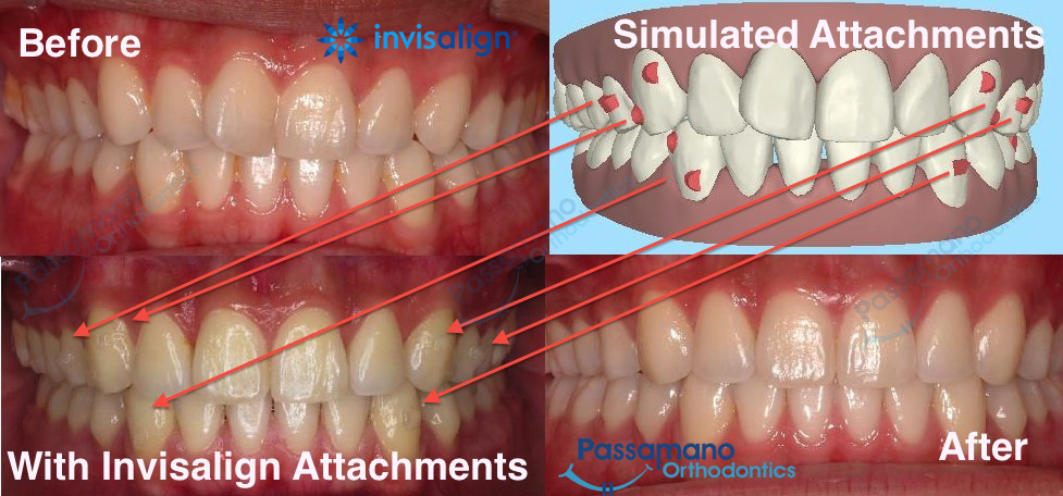 What Are Invisalign Attachments? | Passamano Orthodontics Irvine, CA ...