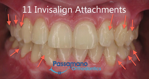 Invisalign Attachments copy