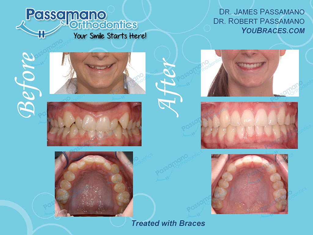 High Canines to Perfect Smile with Braces - Passamano Orthodontics