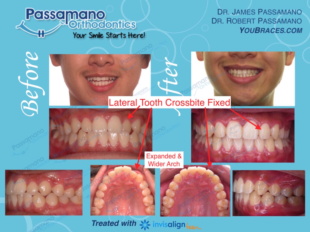 Incisor Tooth Crossbite! Fixed with Invisalign Teen - Passamano ...