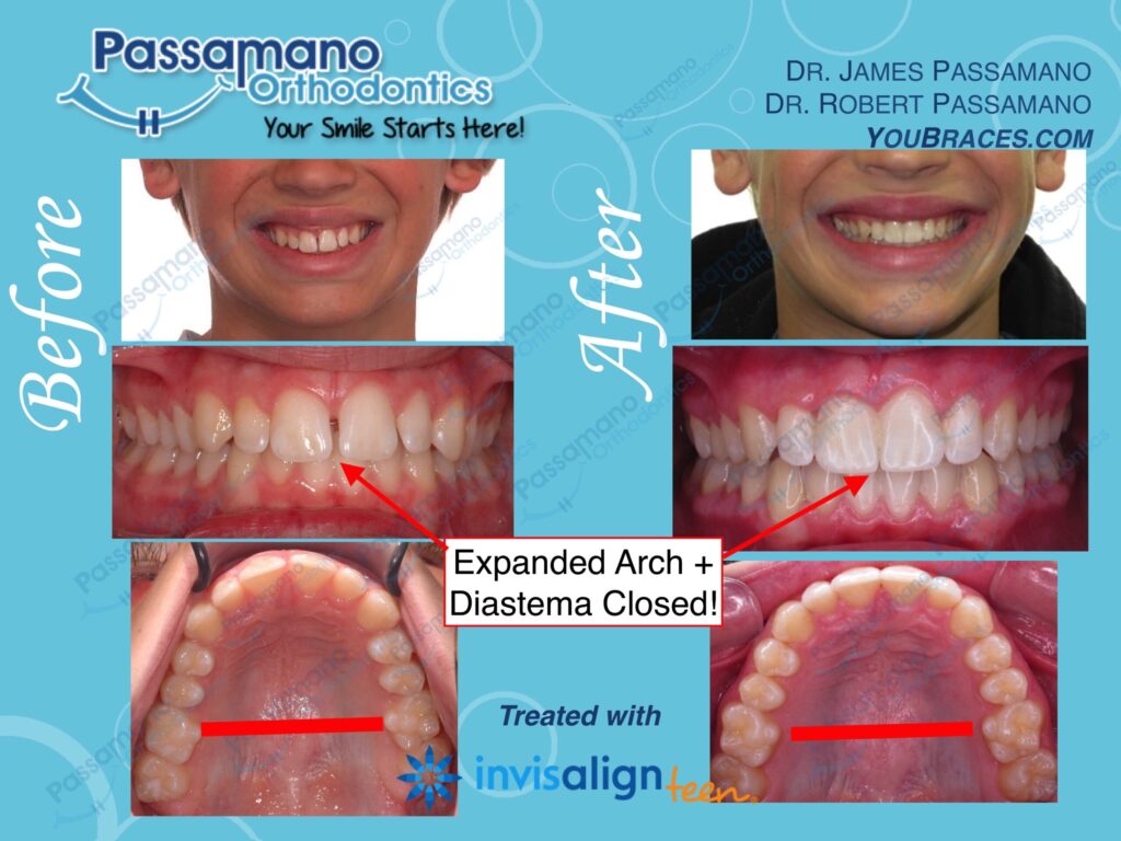 Wider Smiles and No More Space Between Front Two Teeth with Invisalign