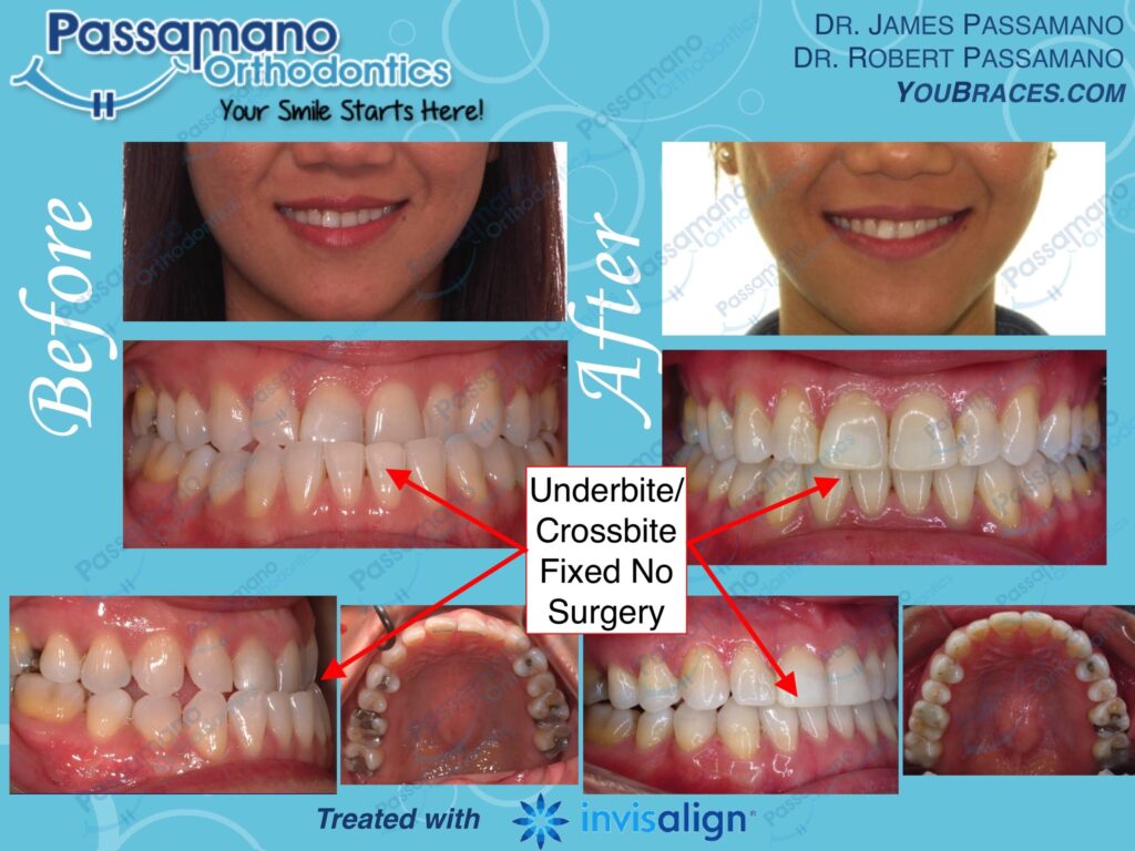 Underbite Fixed using Invisalign without Surgery - Passamano Orthodontics