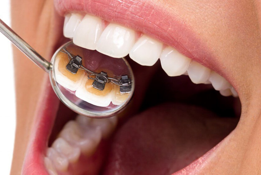 Invisible Braces are Here! Introducing Lingual (Behind the Teeth) Braces