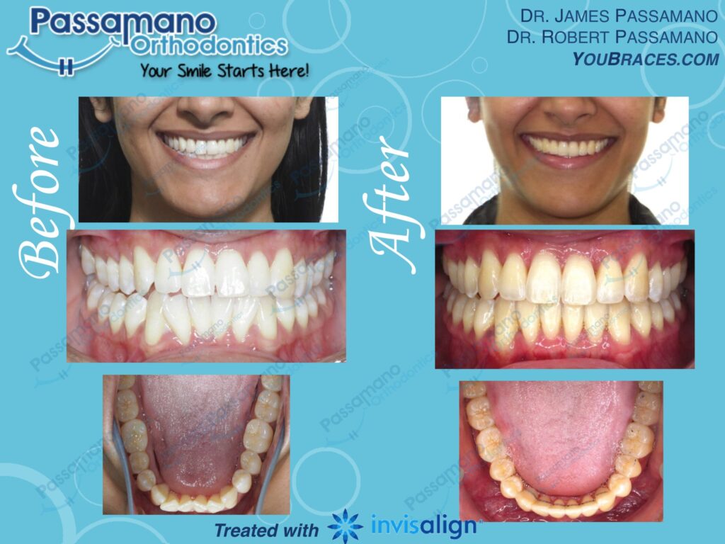 Lower Crowding Fixed with IPR and Permanent Retainer, A++ Passamano