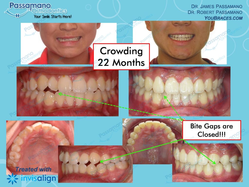 Underbite Invisalign Teen with Lower IPR Passamano Orthodontics