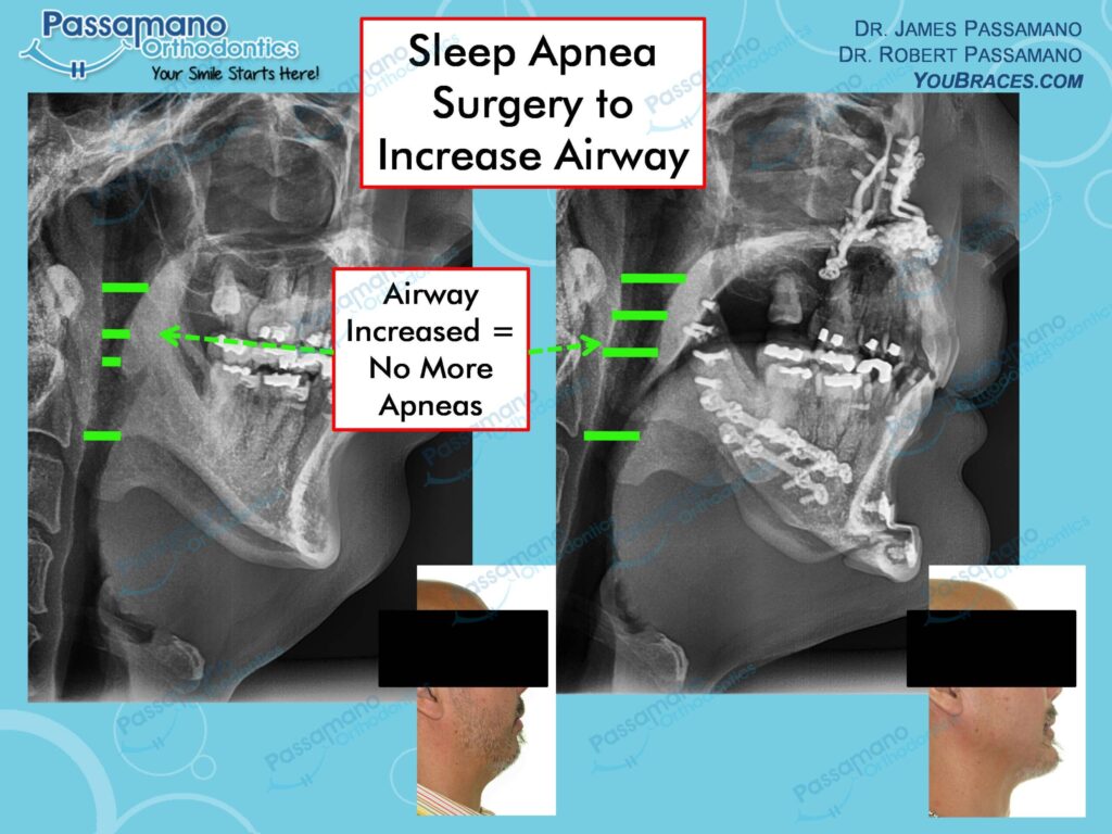 Sleep Apnea Surgery to Improve Airway Passamano Orthodontics