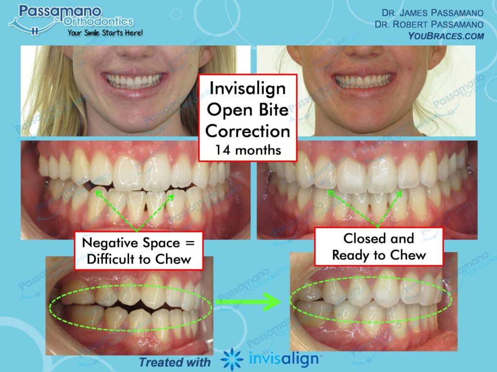 Lateral Open Bite Female Invisalign 14 Months Passamano Orthodontics