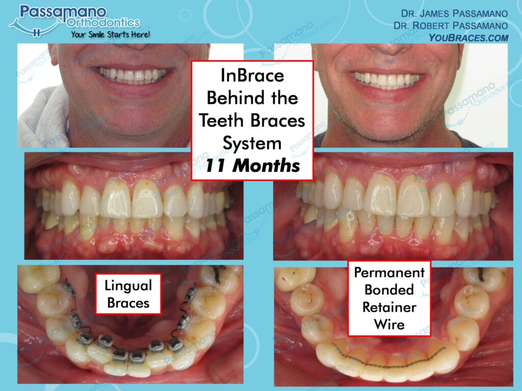 Lingual Behind the Teeth Braces with Permanent Bonded Wires Passamano Orthodontics