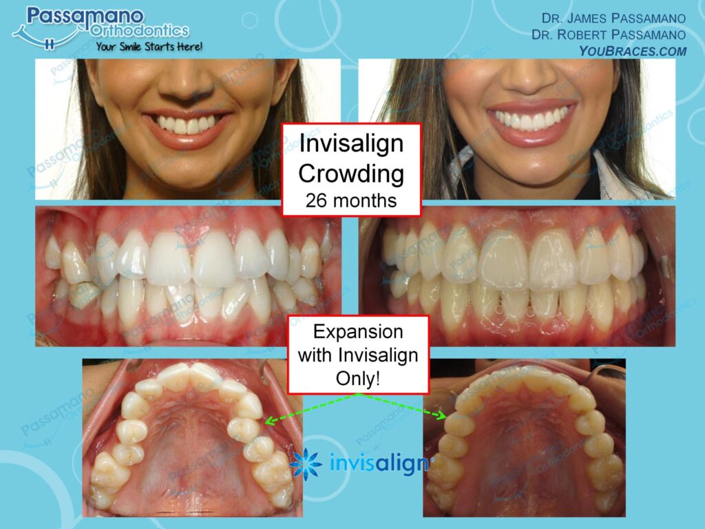 invisalign-female-widen-pretty-smile-passamano-orthodontics