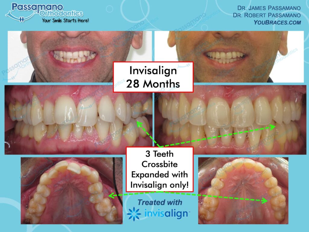 Invisalign Adult Crossbite and Great Result - Passamano Orthodontics