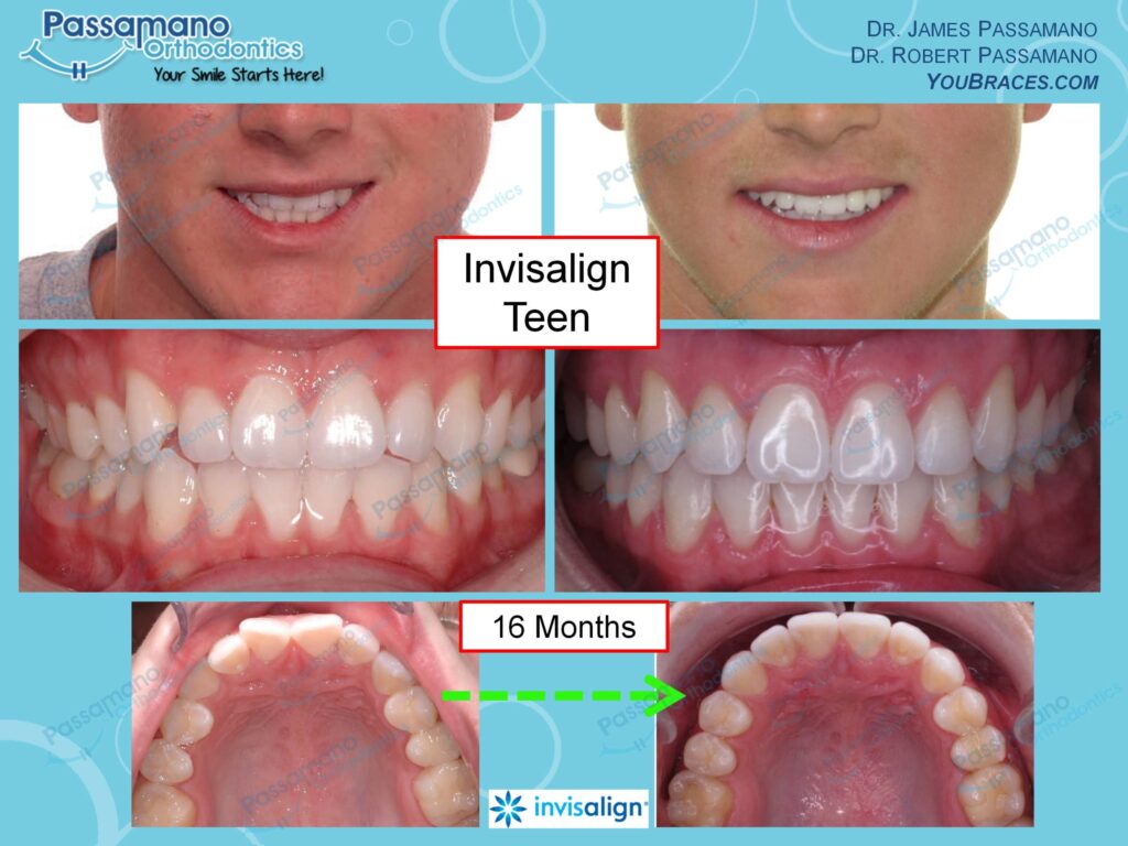 Invisalign Teen Anterior Crowding with Lack of Vertical Overlap ...