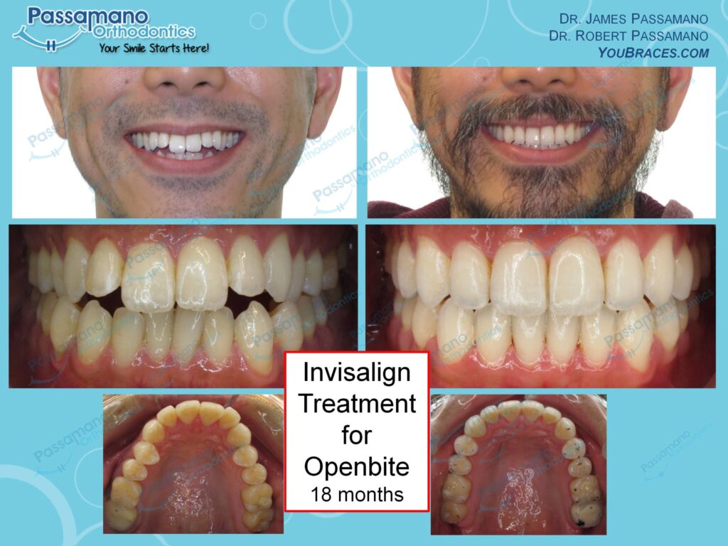 Male Invisalign Open Lateral Incisors - Passamano Orthodontics