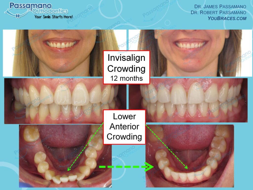 Invisalign Lower Crowding Adult Female Missing Tooth - Passamano 