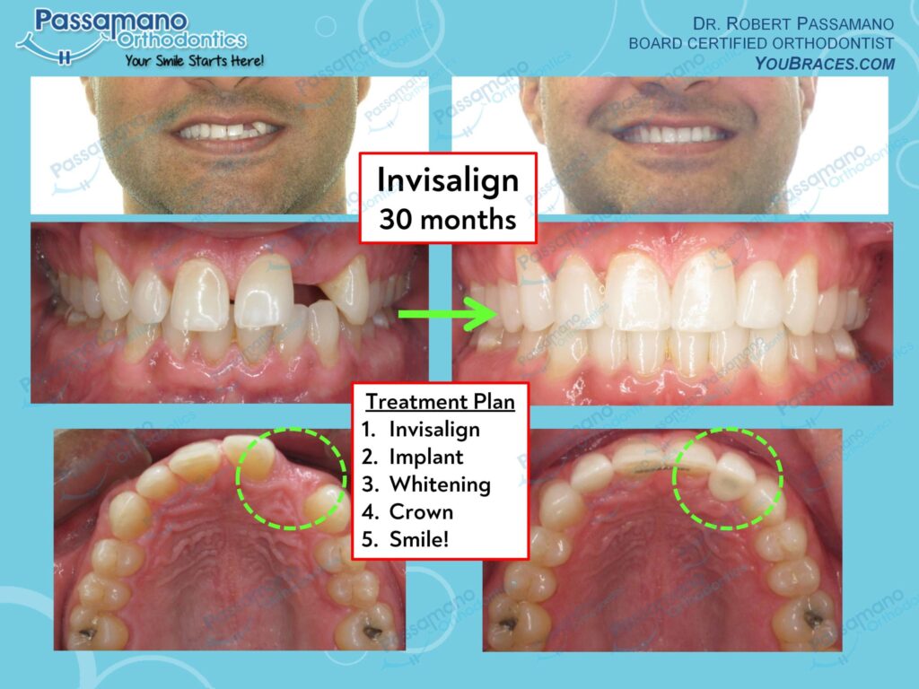 Smile Dental Implant Transformation - Passamano Orthodontics