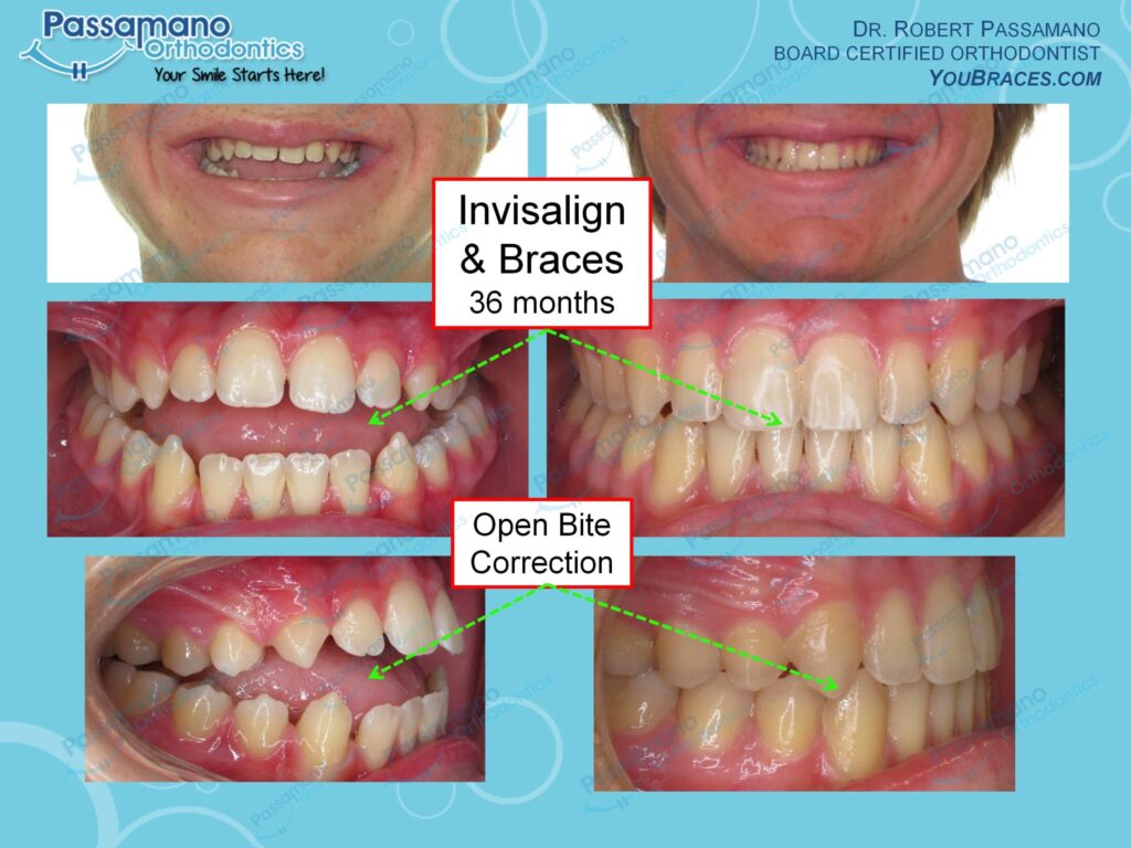 Large Open Bite Closed with Invisalign and Braces Passamano Orthodontics