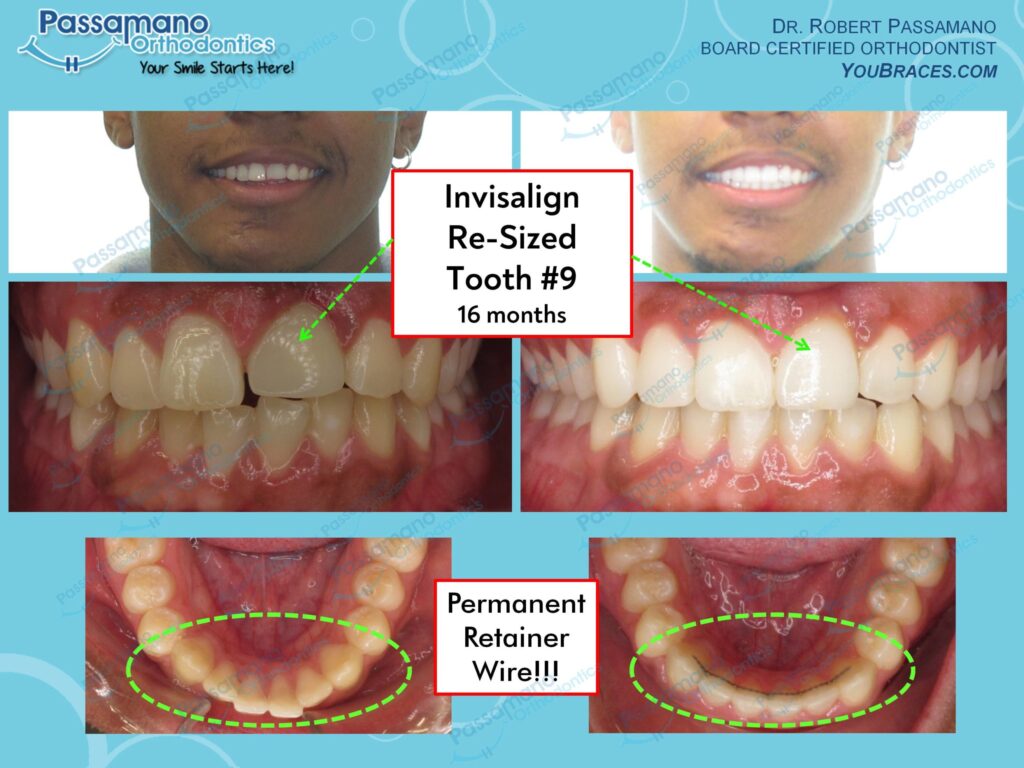 Invisalign Alignment and Tooth 9 Implant New Crown Passamano Orthodontics