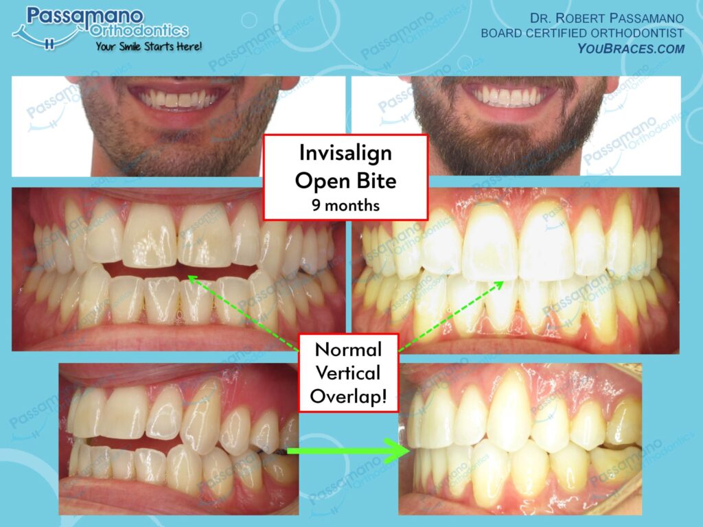 Invisalign Open Bite Correction 3mm Male Adult Passamano Orthodontics