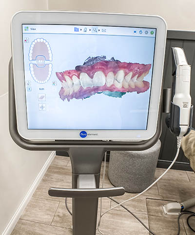 3D Digital Scanning - Passamano Orthodontics - Irvine CA