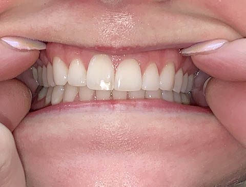 Smile Selfie - Center, Teeth Together - Free Virtual Orthodontic Consultation - Passamano Orthodontics - Irvine CA