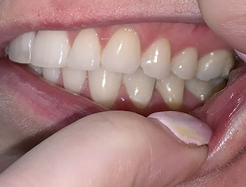 Smile Selfie - Left Side - Free Virtual Orthodontic Consultation - Passamano Orthodontics - Irvine CA