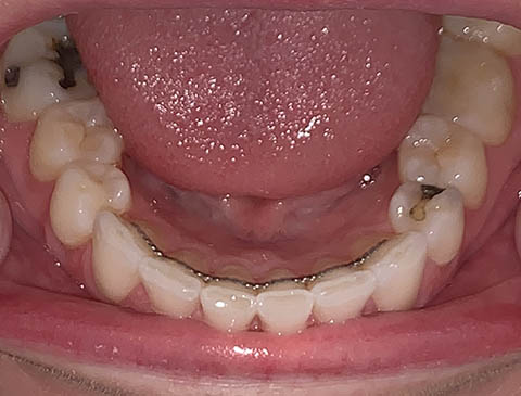 Smile Selfie - Lower Arch - Free Virtual Orthodontic Consultation - Passamano Orthodontics - Irvine CA