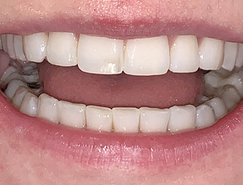 Smile Selfie - Teeth Apart - Free Virtual Orthodontic Consultation - Passamano Orthodontics - Irvine CA