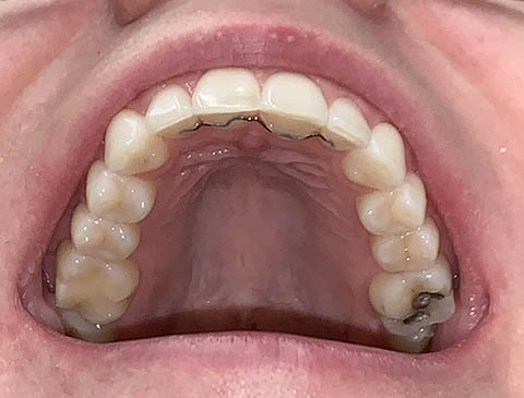Smile Selfie - Upper Arch - Free Virtual Orthodontic Consultation - Passamano Orthodontics - Irvine CA