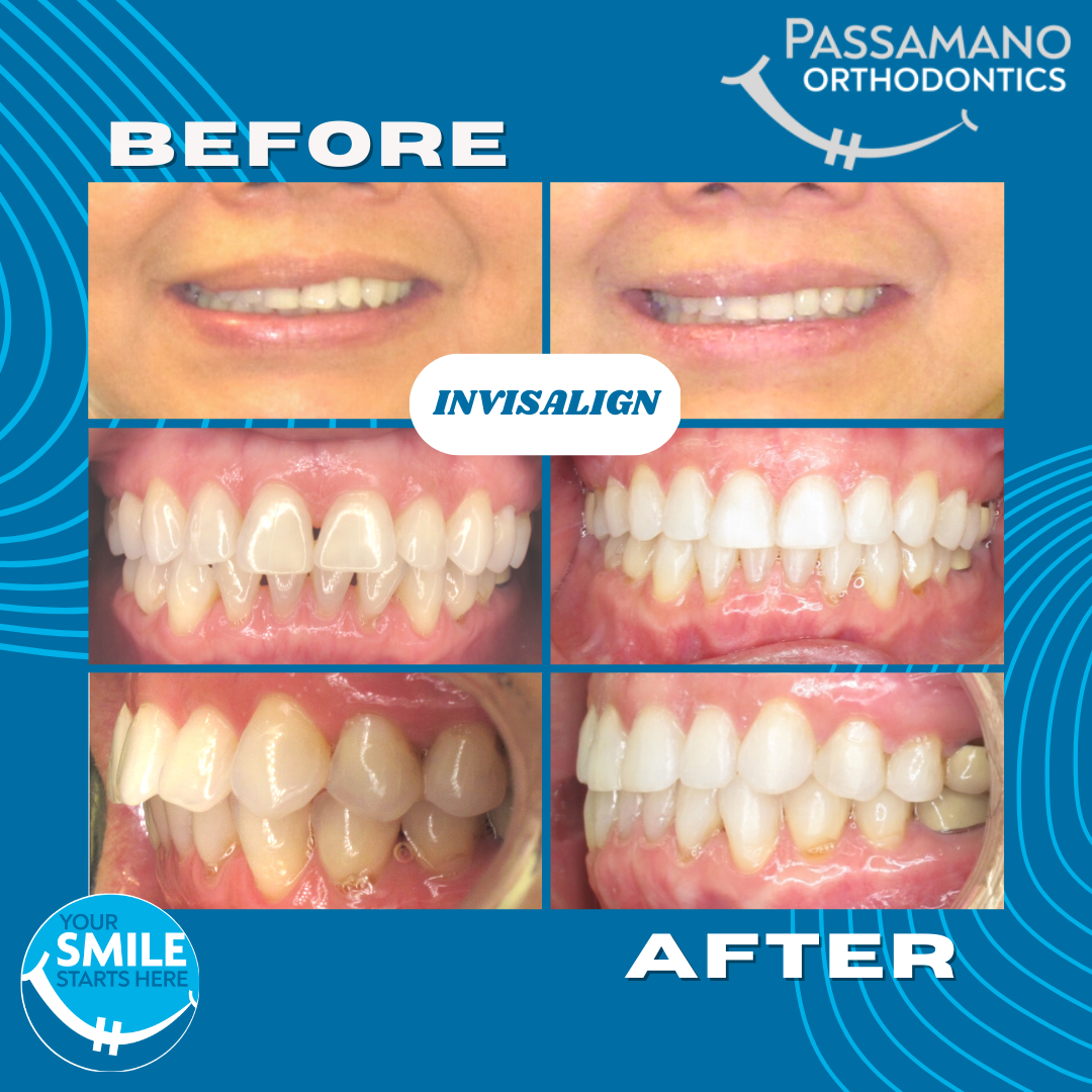 Black Triangle Reduction with Invisalign - Passamano Orthodontics