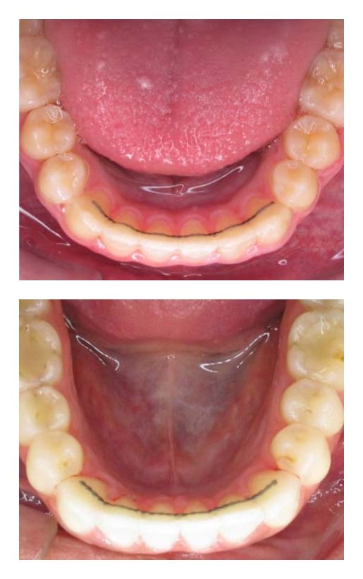 Bonded Lower Retainers - Passamano Orthodontics - Irvine, CA