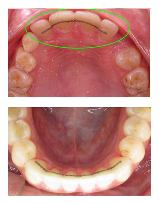 Bonded Retainer Wires - Passamano Orthodontics - Irvine, CA