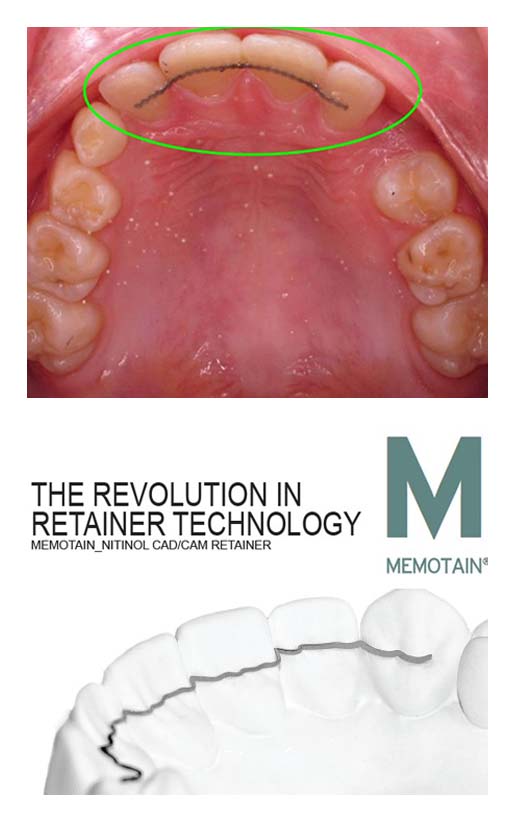 Bonded Upper Retainers - Passamano Orthodontics - Irvine, CA