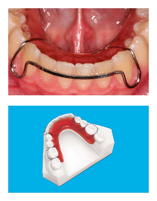 Hawley Retainer Lower - Passamano Orthodontics - Irvine, CA