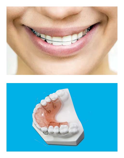 Hawley Retainer Upper - Passamano Orthodontics - Irvine, CA