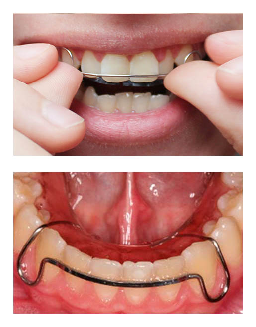 Hawley Retainers - Passamano Orthodontics - Irvine, CA