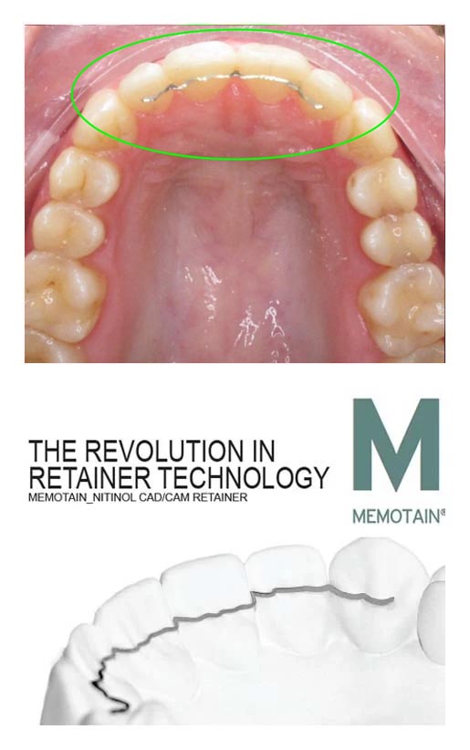 Bonded Upper Retainers - Passamano Orthodontics - Irvine, CA