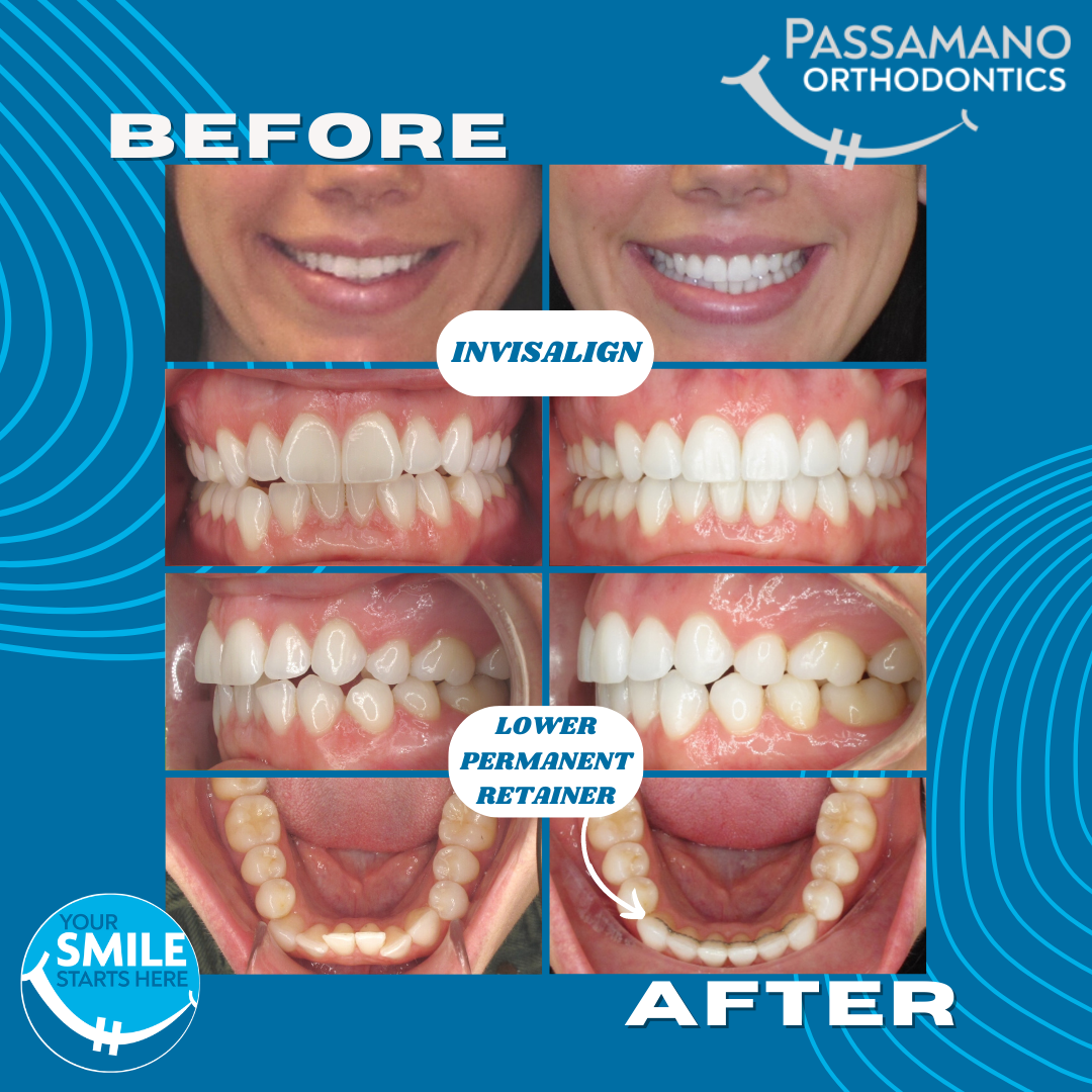 Invisalign Before and After Stories With Our Patients - Gorman and Bunch  Orthodontics - Carmel, IN