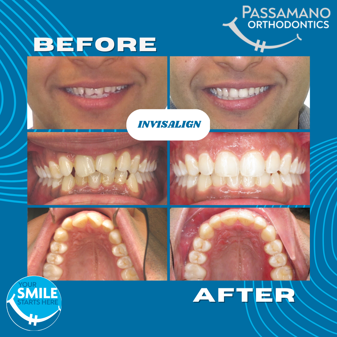 Smile Transformations with Invisalign